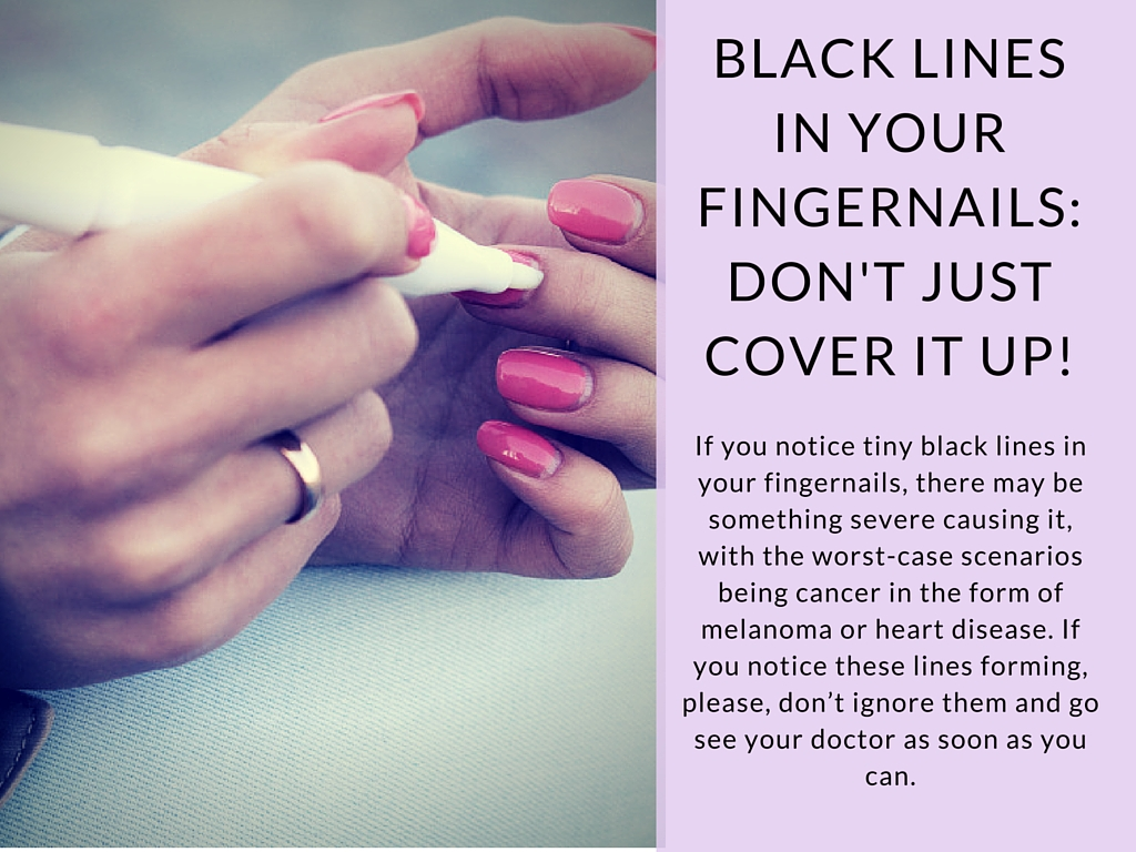 Normal Black Line Under Fingernail vs. Melanoma Streak ...