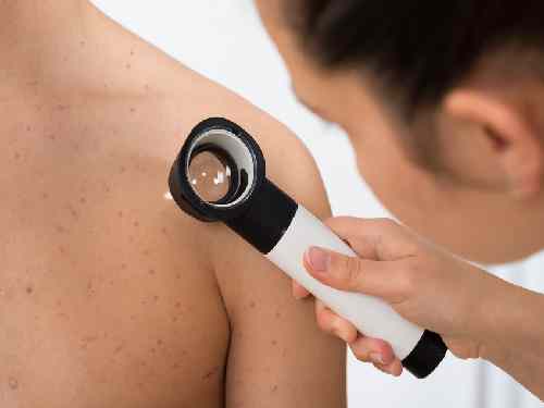 How can you prevent welts from turning into scars?