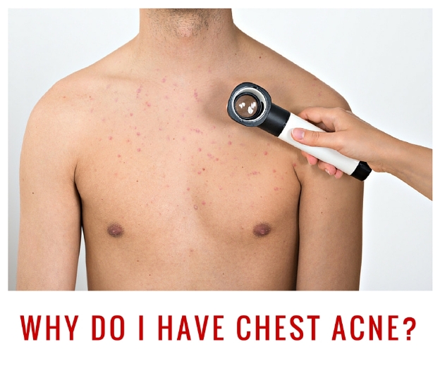 How to Treat Chest Acne, Pimples, Scars, and Bumps
