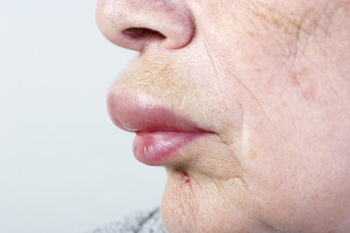 Itchy Lips! - Dermatology - MedHelp