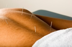 Acupuncture Can Help Fight Prostate Pain