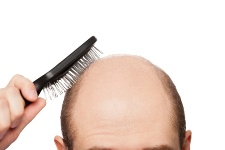 Going bald may be an indicator of greater health problems.