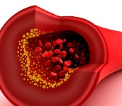 Atherosclerosis is the leading cause of ill health and death