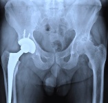 There are many known problems about metal-on-metal hip implants.