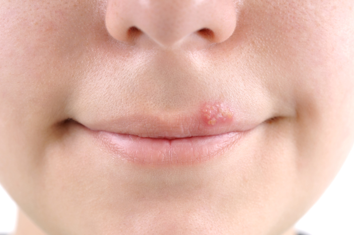 How to Prevent a Cold Sore