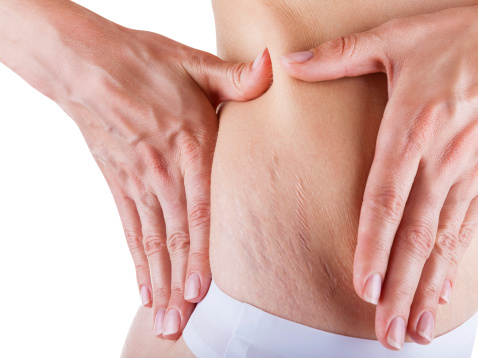 Stretch Marks for Youthful Skin
