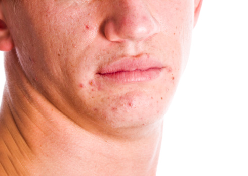 causes of acne