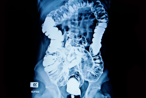 ruptured bowel
