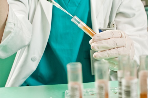 Prostate cancer and urine test