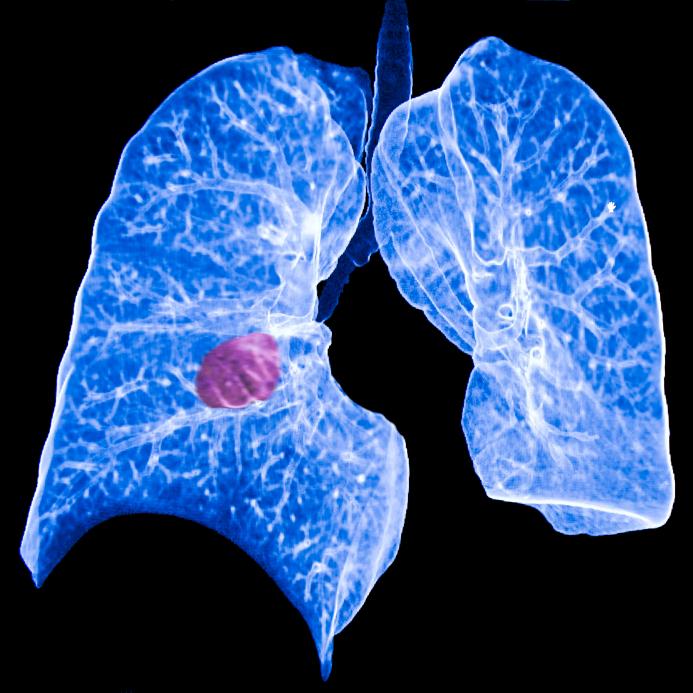 type of lung cancer