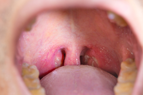 Cryptic Tonsils