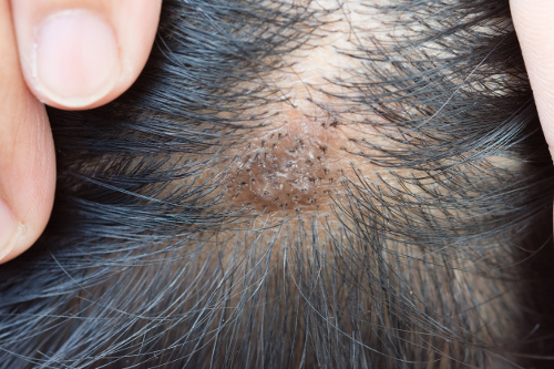 Scabs on Scalp