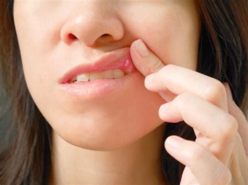 Are Canker Sores Contagious