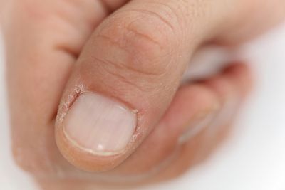 Skin around Nails Peeling? Vitamin Deficiency and Other Causes