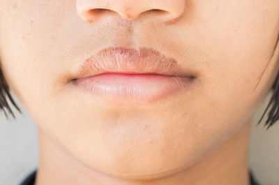 lip dermatitis